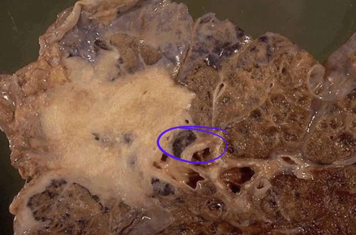 <p>Identify the <strong>organ</strong> and the <strong>diagnosis</strong> in this format: <em>diagnosis, organ</em></p>
