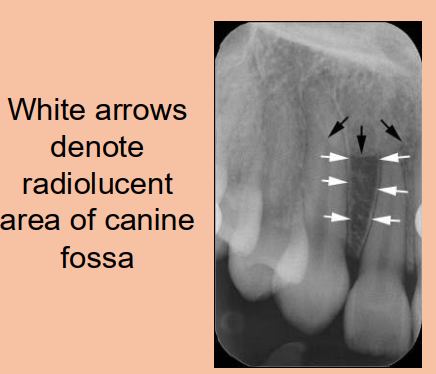 <p>The depression in the maxillae lateral to the canine </p><p></p>