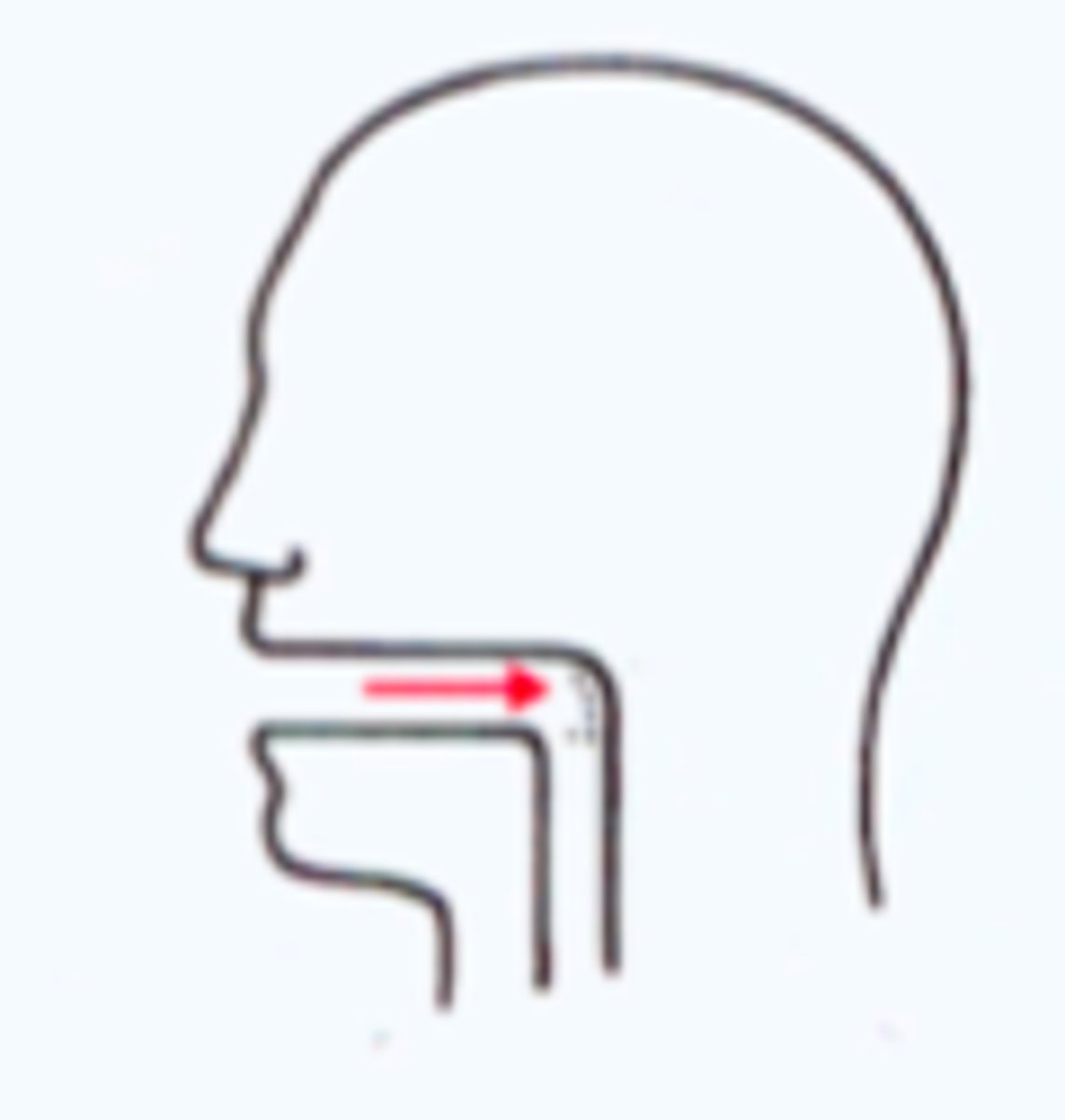 <p>impaction</p>