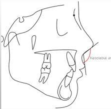 <p>-angle formed by the upper lip and the nose</p><p>-recorded as: normal (90 degrees), acute, obtuse</p>
