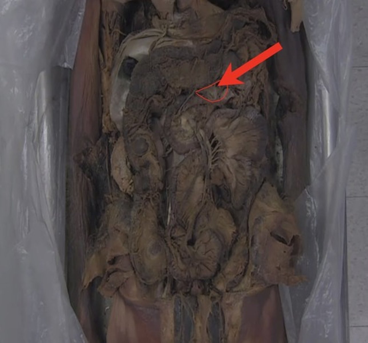 <p>(any sheet running from transverse colon posteriorly)</p>