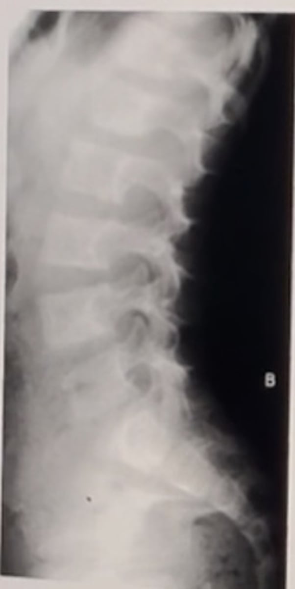 <p>neurofibromatosis</p><p>3 multiple choice options</p>