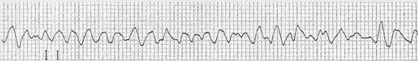 <p>irregular; no P waves, QRS complexes, or T waves</p>