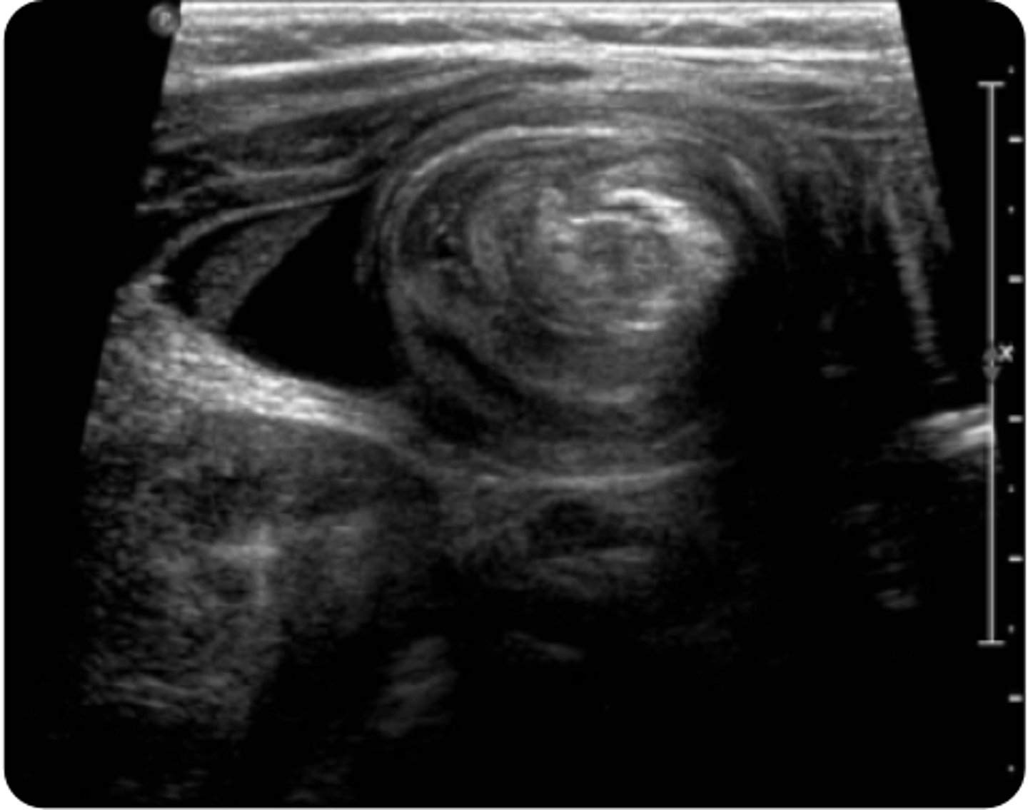 <p>An 18-month-old boy presents to the emergency department with his parents for what they believe to be abdominal pain for the past 2 hours. The patient has been experiencing episodes of inconsolable crying that last around 15 minutes. During these times, the patient draws his legs up to his abdomen and cries. Between crying episodes, the patient appears lethargic. He also vomited twice in the car on the way to the hospital. Of note, the patient’s father was ill 3 days ago with vomiting and diarrhea. The patient’s vital signs are a blood pressure of 100/60 mm Hg, a heart rate of 110 bpm, a respiratory rate of 18 breaths per minute, an oxygen saturation of 96%, and a temperature of 100.6°F. Upon physical examination, the lungs are clear to auscultation and a cardiac exam reveals a regular rate and rhythm with no murmurs, gallops, or rubs. An ENT examination is within normal limits. Upon abdominal examination, a sausage-shaped mass is palpable in the right upper quadrant. A genital examination reveals grossly bloody stool in the diaper. An abdominal ultrasound is obtained and is shown above. Which history, clinical manifestation, or exam finding is most likely associated with the suspected diagnosis?</p><p>AFamily history of gastroenteritis</p><p>BFever</p><p>CLethargy</p><p>DRelapsing-remitting pain episodes</p>