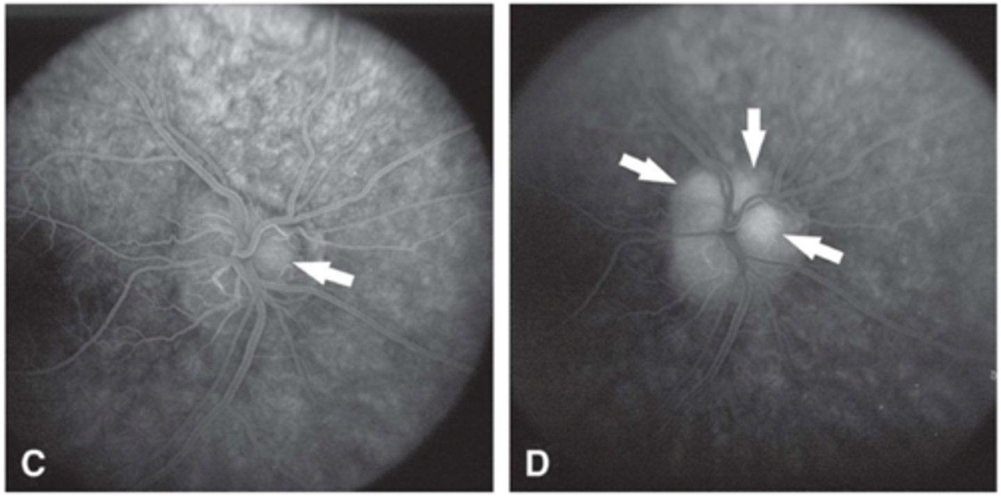 <p>nodular staining</p>