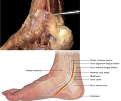 tight flexor retinaculum leading to tendon constriction posterior to medial malleolus