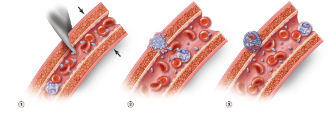 <p>What are the three stages of hemostasis? </p>