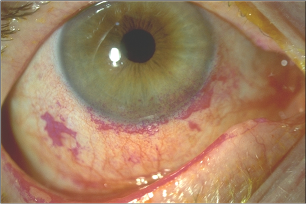 <ul><li><p><mark data-color="red" style="background-color: red; color: inherit;">chronic red eye</mark> - lid margin &amp; <mark data-color="red" style="background-color: red; color: inherit;">conjunctival hyperaemia</mark>&nbsp;</p></li></ul><p></p><ul><li><p><mark data-color="green" style="background-color: green; color: inherit;">punctate epithelial erosion</mark> (lower 1/3rd of cornea) →purple dots in image&nbsp;</p></li></ul><p></p><ul><li><p><mark data-color="green" style="background-color: green; color: inherit;">conjunctival staining</mark> - fluorescein etc</p></li></ul><p></p><ul><li><p>marginal keratitis + scarring&nbsp;</p></li></ul><p></p><ul><li><p><mark data-color="green" style="background-color: green; color: inherit;">neovascularisation</mark> —> new blood vessels + <strong>pannus </strong>(opacification of cornea)</p></li></ul><p></p><p></p>