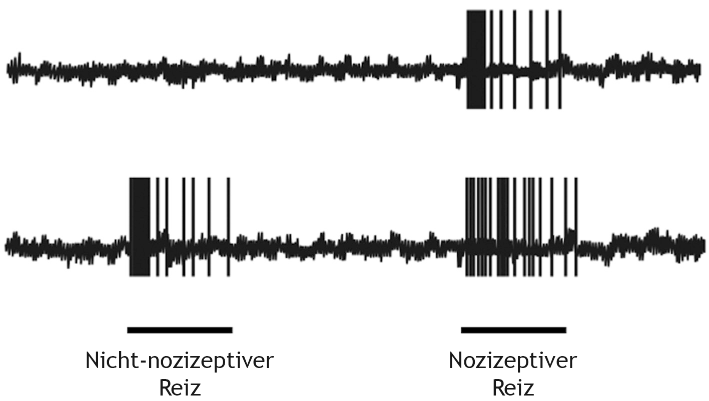 <p>15. The response behavior of an isolated nociceptor is shown before (upper recording) and after (lower recording) application of substance X.</p><p>Which of the following best describes the effect of substance X in this experiment?</p><p>The effect of substance X shown in the figure</p><p>A. Increases the basal activity of the nociceptor</p><p>B. Is typical of a Na⁺ channel blocker</p><p>C. Is analgesic</p><p>D. Sensitizes the nociceptor</p><p>E. Is blocked by application of a cyclooxygenase inhibitor</p>