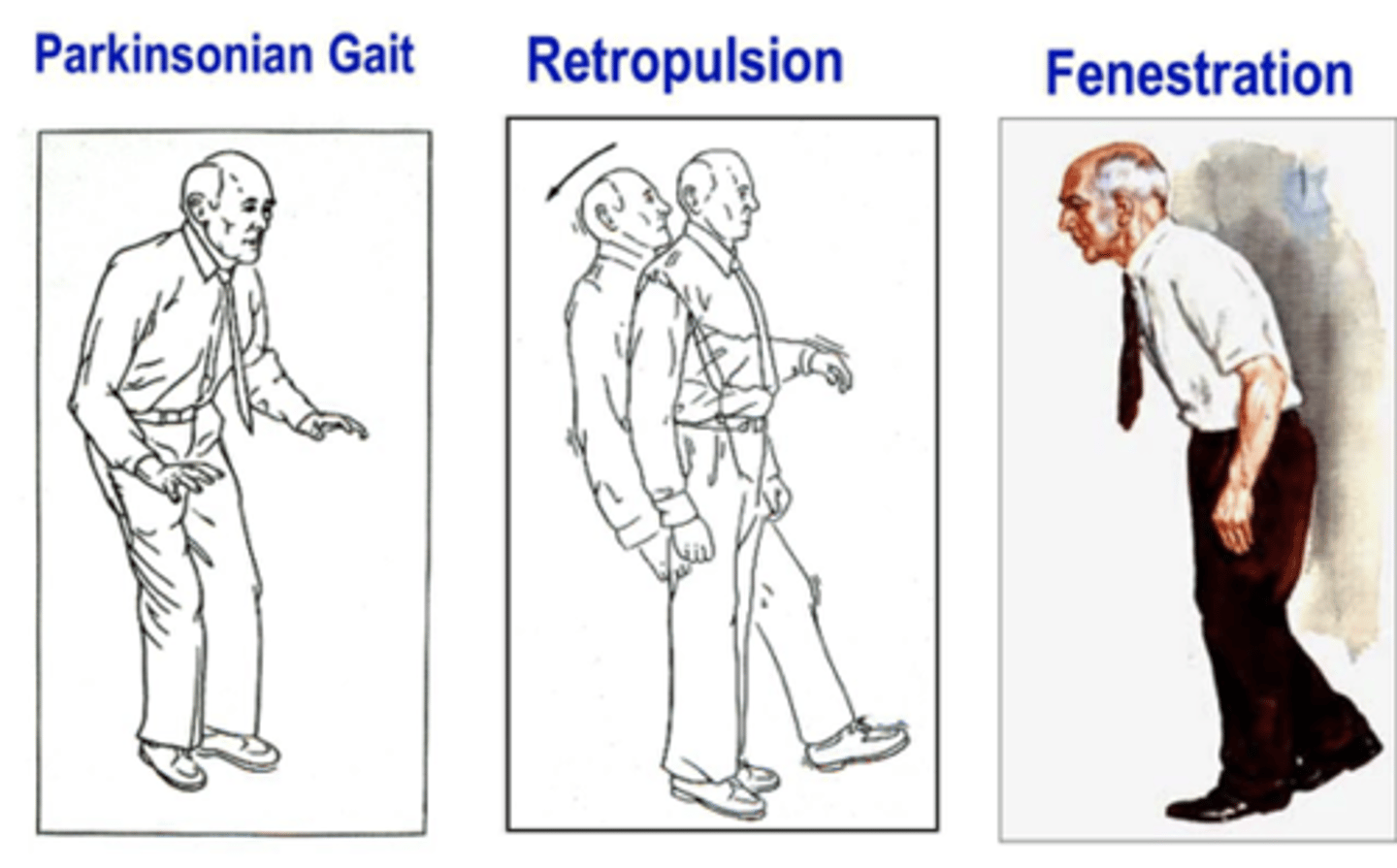 <p>retropulsion</p>