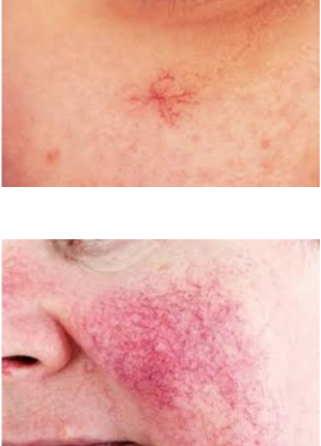 <p>spider star or spider angioma, rosacea</p>