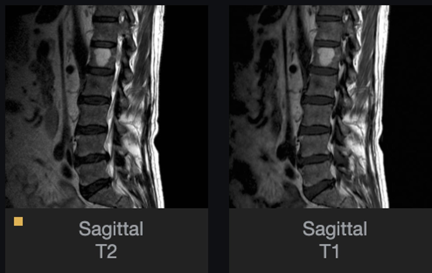 <p>Describe the bone lesion</p>