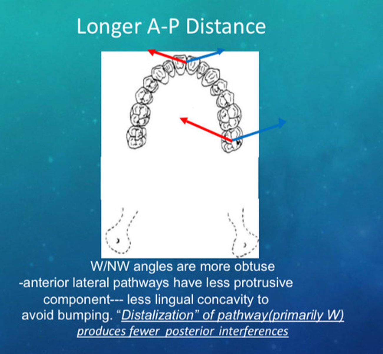 <p>1) W/NW angles are more obtuse</p><p>2) anterior lateral pathways have less protrusive component</p><p>3) less lingual concavity to avoid bumping</p><p>4) distalization of pathway (primarily W) produces fewer posterior interferences</p>