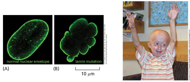 <p>lines inside of nuclear envelope</p><p>lamin protein</p><p>provides mechanical stability and may be involved in chromosome positioning</p><p>lamin mutation — rare genetic disorder (type of progeria). signs of aging begin in childhood; mechanism unclear</p>
