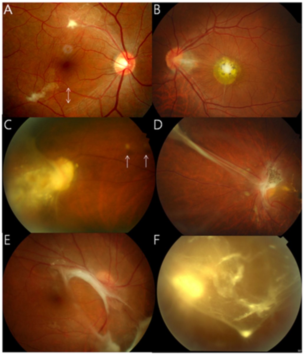 <p>central posterior granuloma</p><p>peripheral granuloma</p><p>chronic endophthalmitis</p>