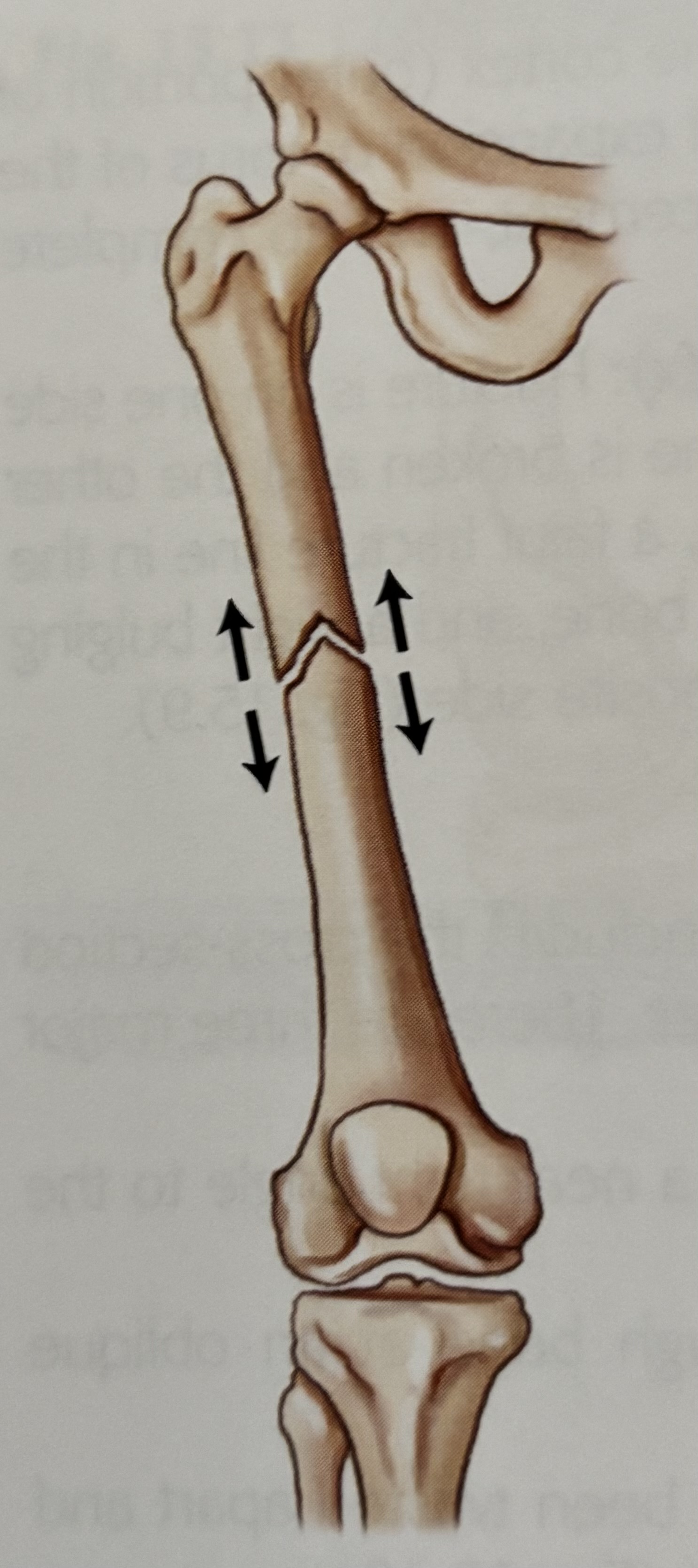 <p>What type of fracture is this?</p>