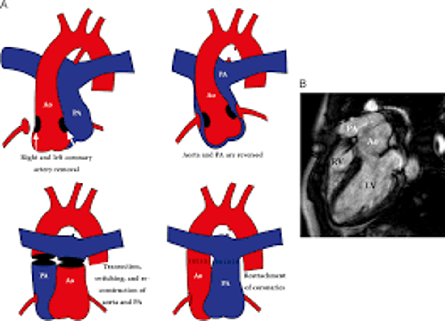 <p>cutting the main pulmonary artery and moving it anterior to the aorta before reattaching the pulmonary artery during the following reconstruction of the great vessels.</p>