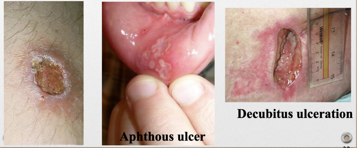 <p>ex. aphthous ulcer, decubitus ulcer</p>