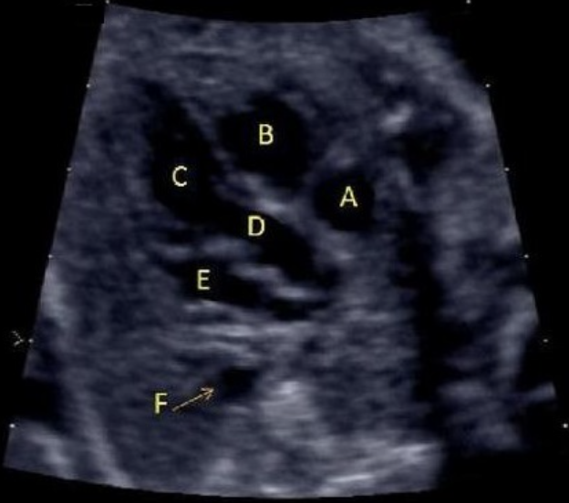 <p>letter A is </p><p>a) left atrium</p><p>b) RVOT</p><p>c) LVOT</p><p>d) right ventricle</p><p>e) right atrium </p>