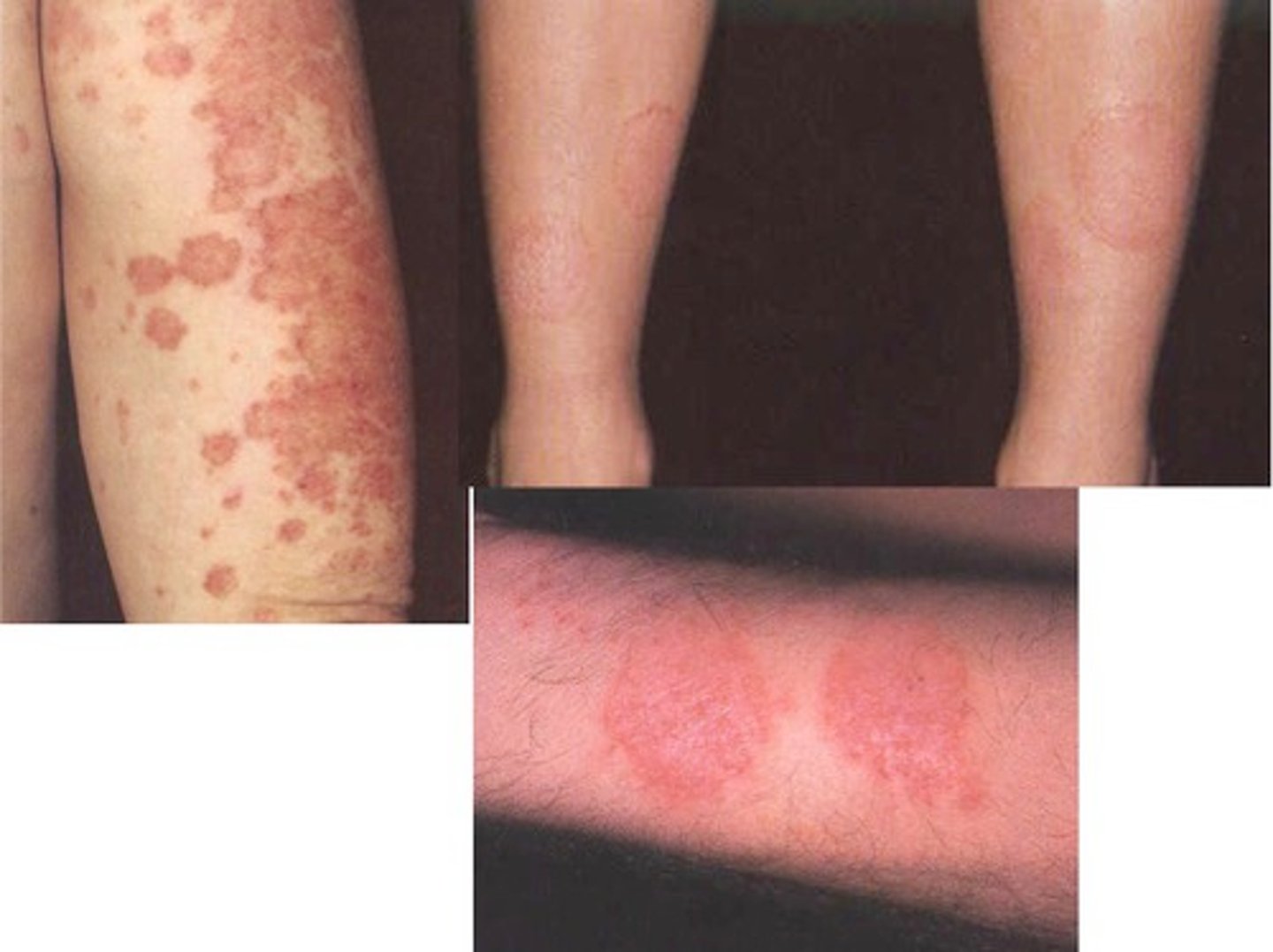 <p>poorly defined, have borders merging into normal skin (nummular eczema)</p>