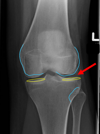 <p>MAIN: femoral condyles are symmetrical</p><p>SUPPORTING:</p><ul><li><p>½ of fib head SI by tib</p></li><li><p>intrcndyl em centered between notch</p></li></ul><p></p><p>int.rot</p><ul><li><p>lat.con wider</p></li><li><p>less than ½ fib head SI</p></li></ul><p>ext.rot</p><ul><li><p>med.con wider</p></li><li><p>more than ½ fib head SI</p></li></ul><p></p>