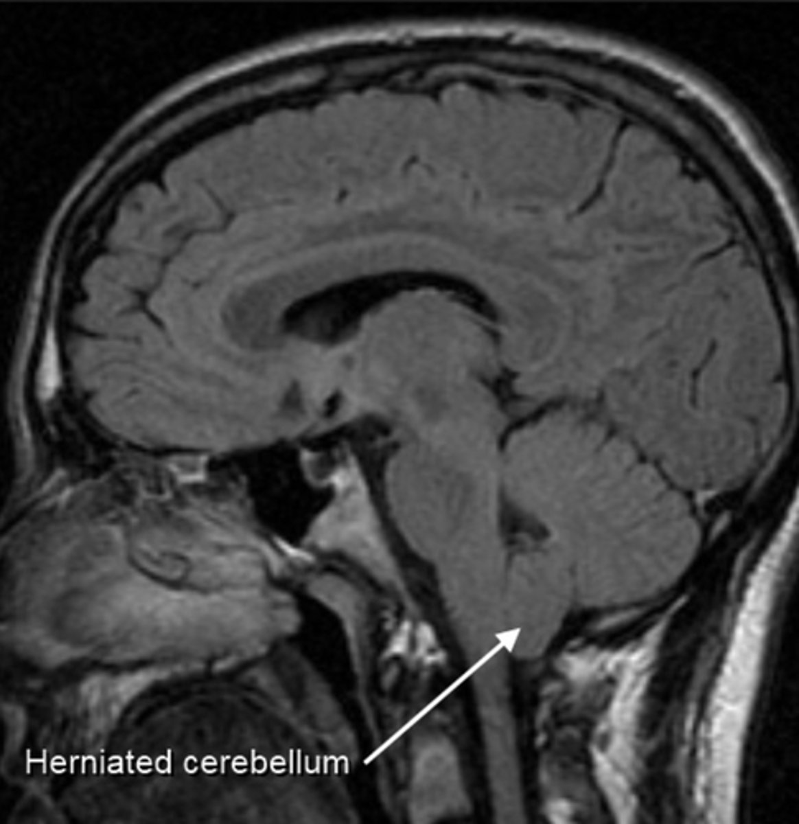 <p>this is an anatomical/congenital condition in which the brain tissue extends into spinal cord and occurs when there is an abnormality pressing on the brain and forcing it downward; CSF is blocked; discontinuous hydrocephaly.</p>