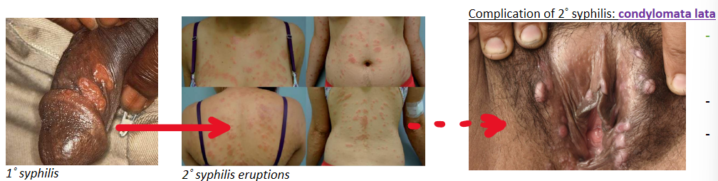 <p>STI caused by treponema pallidum</p><p><u>Complications</u>:</p><ul><li><p>Can progress to 2˚ syphilis causing condylomata lata (flat, wart-like lesions)</p></li><li><p>Late stage syphilis fatal if untreated</p></li></ul><p><u>Symptoms:</u></p><ul><li><p>Appear 2 weeks after infection</p></li><li><p>Chancre’s: small lesions on genitalia without inflammation</p></li><li><p>2˚ syphlis: disseminate to rest of the body 5-8 weeks after initial symptoms resolve</p></li><li><p>Late stage syphilis: insanity and death</p></li></ul><p><u>Diagnosis</u>:</p><ul><li><p>Serology of blood sample using EIA, later confirmed by rapid plasma receptor antigens (RPR) or TPPA (T. pallidum plasma agglutination)</p></li><li><p>Swab of ulcer for T. pallidum (specialist only)</p></li></ul><p><u>Treatment</u>: benzathine penicilin (all stages)</p><p></p>