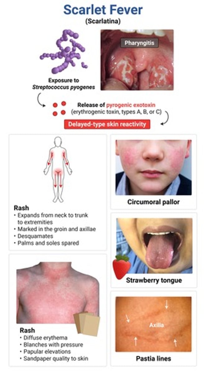 <p>scarlet fever → GAS type IV hypersensitivity rxn</p><p>typically occurs w/in 1-2 days of strep infxn</p><p>tx = PCN or amox (preferred in kids)</p>