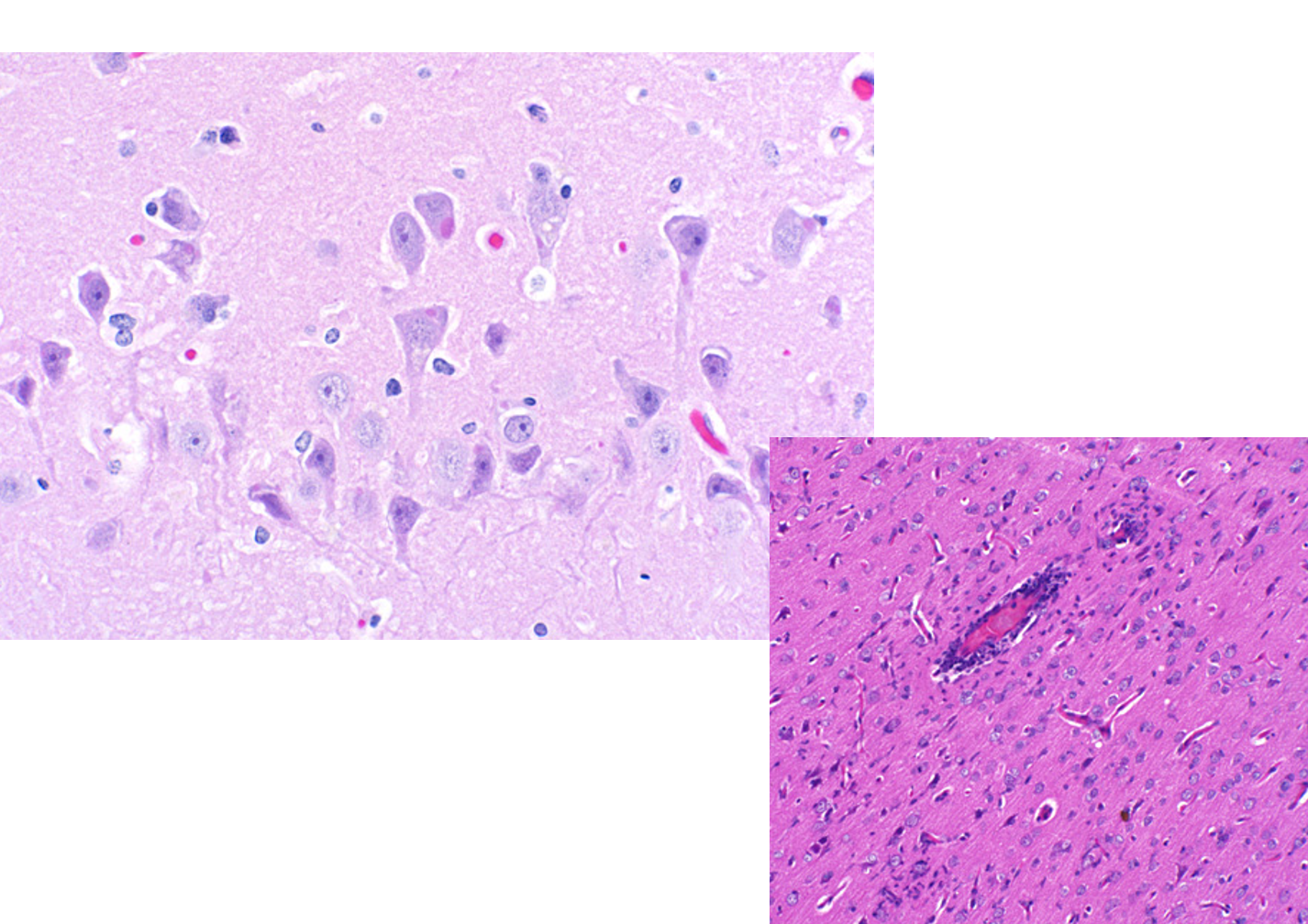 <p>Tissue from a mink. Which is true regarding the pathogenesis of this disease?</p><p class="MsoListParagraphCxSpFirst"><span>a.</span><span style="font-size: 7pt; font-family: &quot;Times New Roman&quot;">&nbsp;&nbsp;&nbsp;&nbsp; </span>Induces neuronal apoptosis by the expression of viral protease NS3</p><p class="MsoListParagraphCxSpMiddle"><span>b.</span><span style="font-size: 7pt; font-family: &quot;Times New Roman&quot;">&nbsp;&nbsp;&nbsp;&nbsp; </span>Envelope glycoprotein E (gE) is involved in anterograde viral spread via the olfactory pathway</p><p class="MsoListParagraphCxSpMiddle"><span>c.</span><span style="font-size: 7pt; font-family: &quot;Times New Roman&quot;">&nbsp;&nbsp;&nbsp;&nbsp; </span>Invades neuromuscular junction via conjugation of RVG with the nicotinic acetylcholine receptor</p><p class="MsoListParagraphCxSpLast"><span>d.</span><span style="font-size: 7pt; font-family: &quot;Times New Roman&quot;">&nbsp;&nbsp;&nbsp;&nbsp; </span>Invades neurons via entry receptor PVRL4</p>