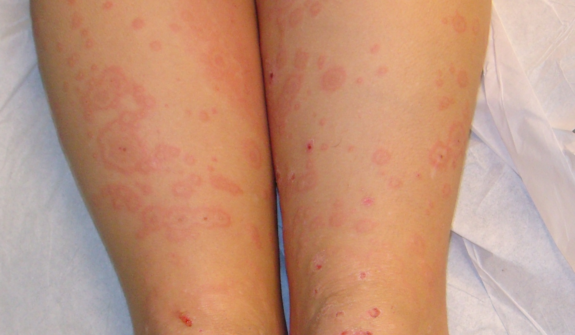 This is a skin rash that is caused by injured or inflamed capillaries.