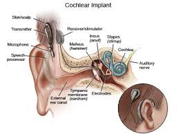 <p>a device for converting sounds into electrical signals and stimulating the auditory nerve through electrodes threaded into the cochlea</p>