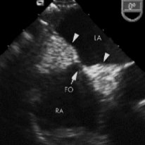<p>Lipomatous hypertrophy of IAS</p>