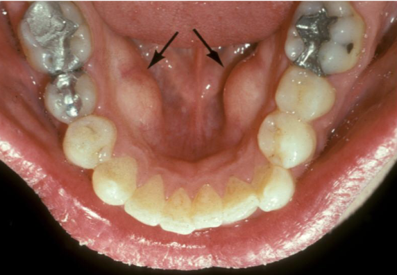 <p>Outgrowths of normal dense bone found on the lingual aspect of the mandible premolar area</p>