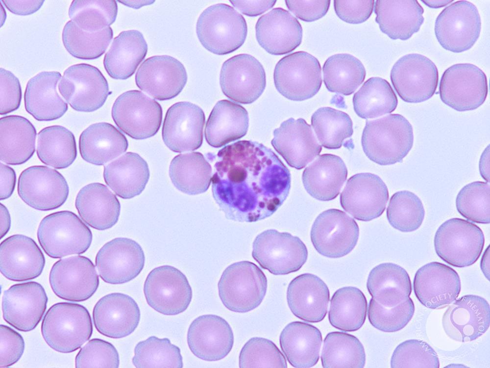 <ul><li><p>presence of purple-gray granules in the cytoplasm of neutrophils</p></li><li><p>causes <u>decreased WBC chemotaxis and bactericidal function</u></p></li><li><p>patients may develop <strong>hepatomegaly</strong>, <strong>liver failure</strong>, or <strong>abnormal bleeding times</strong></p></li><li><p>lymphs and monos may have red granules in their cytoplasm</p></li></ul><p></p>