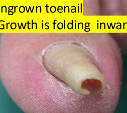 <p>Ingrown toenail causing pain and inflammation. </p>