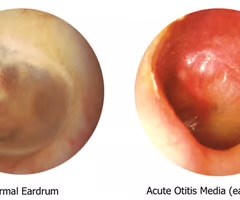 <p>sign of otitis media. It is caused by fluid trapped behind the tympanic membrane, which causes it to bulge.</p>