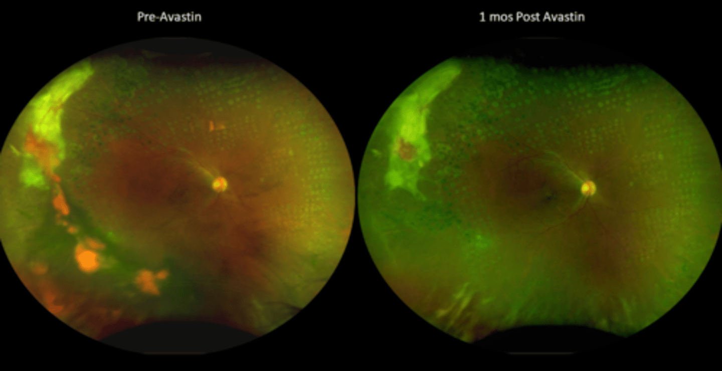 <p>What does PANORAMA suggest for treating PDR with Eylea?</p>