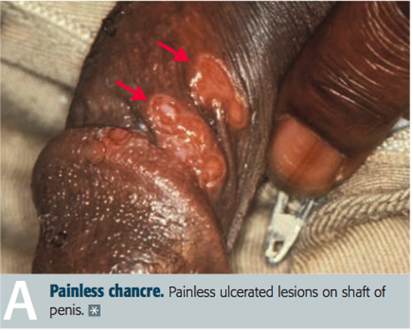 <p>Nonpainful: chancre (syphyilis)</p><p>Painful, exudate: chancroid (Haemophilus ducreyi)</p>