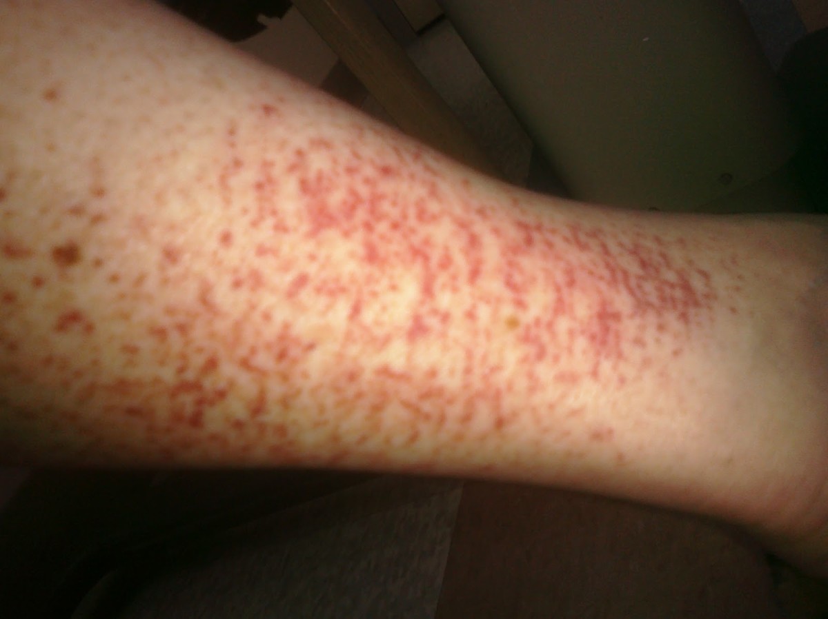 <p>petechiae</p>