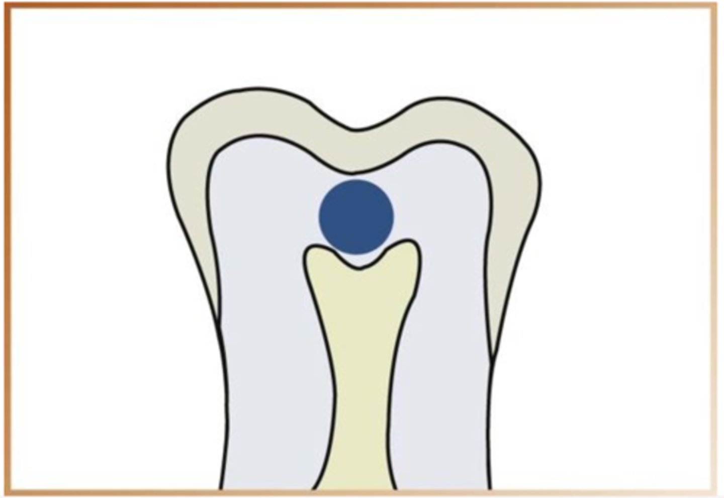 <p>difficult to detect on radiograph due to location but appear as a circular radiolucent area</p>