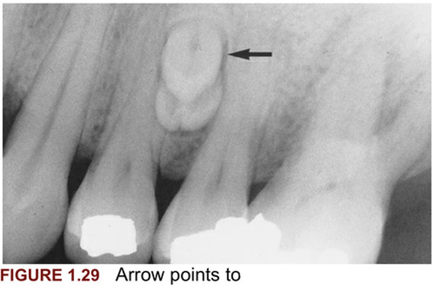 <p>Figure 1.29, Arrow points to what?</p>
