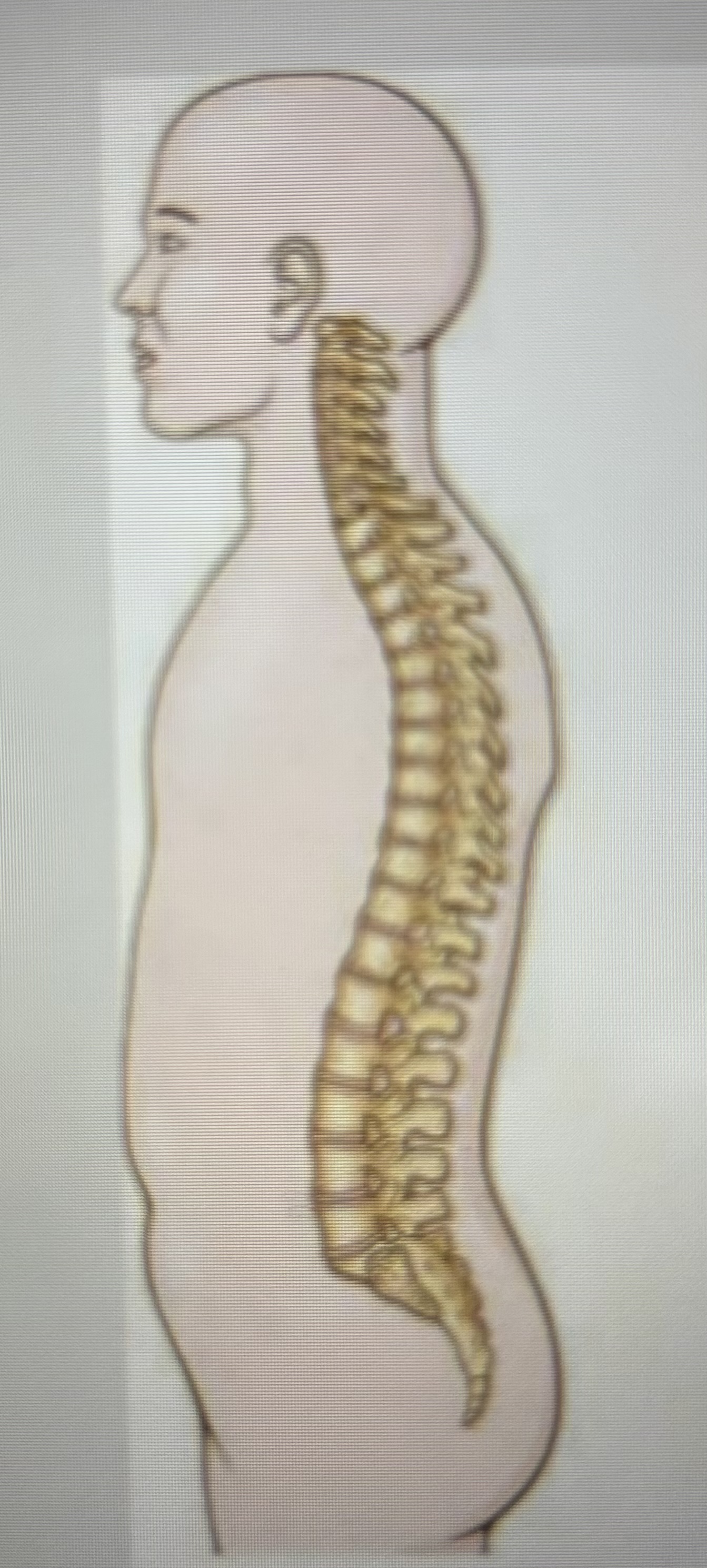 <p>What is this spinal curvature?</p>