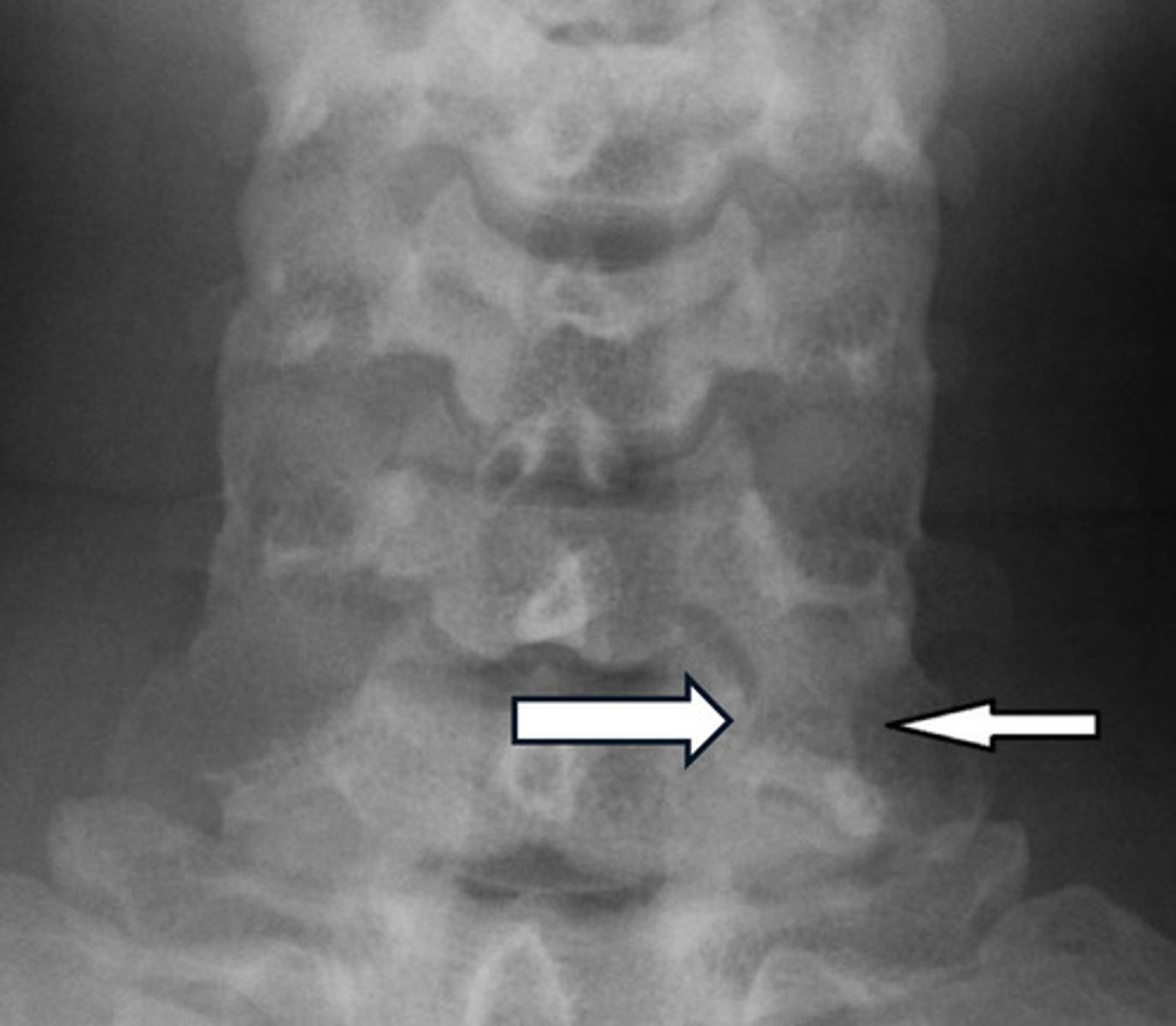<p>Each cervical vertebrae transverse processes are formed by the lateral extension of the center of the neural arches</p><p>The costal portion of the transverse process may enlarge and elongate the anterior tubercle to articulate with the vertebrae below, giving rise to an unusual variant that could simulate a fracture</p>