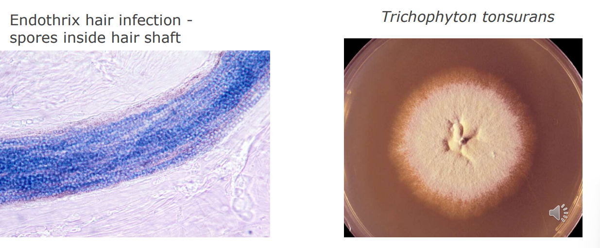 <ul><li><p>Dermatophyte infections - Tinea capitis</p></li><li><p>In UK cities the commonest form is spread <strong><mark data-color="#bdffc3" style="background-color: rgb(189, 255, 195); color: inherit;">anthropophilically - person to person </mark></strong><mark data-color="#bdffc3" style="background-color: rgb(189, 255, 195); color: inherit;">. Clinical presentations may be sub-clinical to kerion</mark>. Often fine scaling, mild erythema, patchy alopecia. Hairs break at skin level -black-dot alopecia.</p></li><li><p>Highly contagious among pre-pubescent children.</p></li><li><p>Practice good hygiene and disinfect chairs and headrests.</p></li></ul><p></p>
