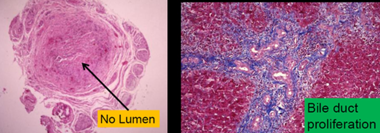 <p>Define Condition:</p><p>Complete or partial obstruction of extrahepatic biliary tree that occurs in first 3 months of life</p><p>-Hx:</p><p>&gt; Fetal = congenital defect</p><p>&gt; Perinatal (MC) = INFLAMMATION</p><p>-Sx/PE:</p><p>&gt; Perinatal:</p><p>&gt;&gt; Persistent Jaundice after 2 wks of life</p><p>&gt;&gt; Dark Urine</p><p>&gt;&gt; Acholic (pale) Stools</p><p>&gt;&gt; Hepatomegaly</p><p>-Dx:</p><p>&gt; Labs:</p><p>&gt;&gt; Elevated CB</p><p>&gt;&gt; Elevated GGT</p><p>&gt; Biopsy</p><p>&gt;&gt; Perinatal:</p><p>&gt;&gt;&gt; Inflammation</p><p>&gt;&gt;&gt; Fibrosing stricture of hepatic or CBD</p><p>&gt; Imaging:</p><p>&gt;&gt; US = A/w Absent/Abnormal Gallbladder</p><p>-Tx:</p><p>&gt; MC reason for pediatric liver transplant</p><p>-Prog:</p><p>&gt; MCC = DEATH from Liver Disease in early childhood</p>
