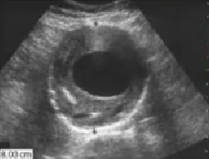 <p>What pathology is seen here? </p>