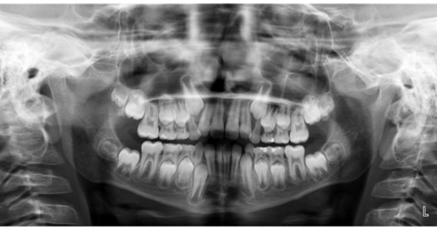 <p>Symmetric condyles?</p>