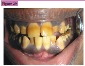 <p>_________ of the teeth due to use of ___________</p>
