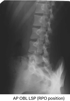 <p>level of L3 at mid spine </p>