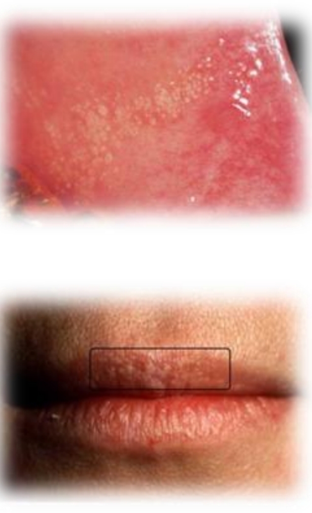 <p>Small yellow-white multifocal papules. Discrete or clustered.</p><p class="has-focus">Asymptomatic</p><p>Second decade of life (puberty)</p><p>Male predilection</p><p class="has-focus is-empty"><strong>Found on:</strong></p><p class="is-empty has-focus">Bilateral buccal mucosa</p><p class="is-empty has-focus">Retromolar pad</p><p class="is-empty has-focus">Upper lip vermilion</p><p></p>